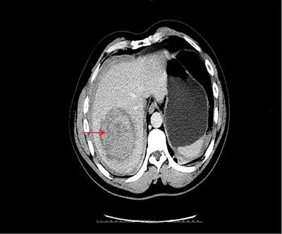 Case Report: Rare Acute Abdomen: Focal Nodular Hyperplasia With Spontaneous Rupture